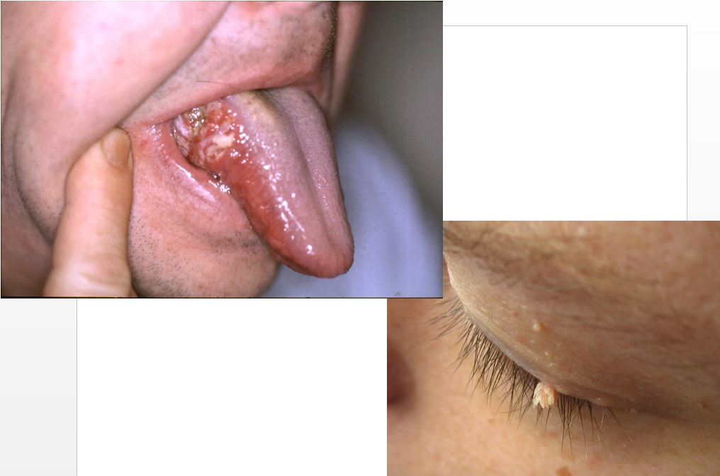 HPV ভ্যাকসিন (Gardasil)