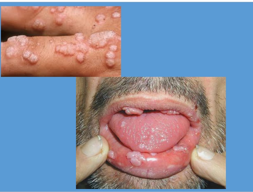 Cervical-Cancer