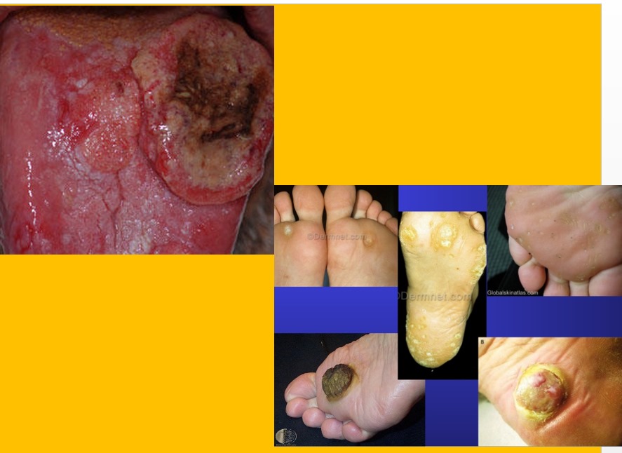 Cervical-Cancer
