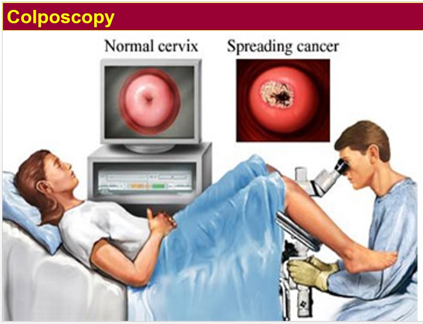 Cervical-Cancer